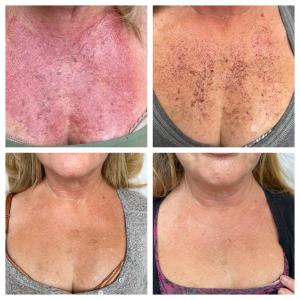 sun damage pic
