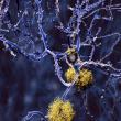 U.S. Transthyretin Amyloidosis Market Projected To Witness Substantial Growth, 2025-2032:Alnylam Pharmaceuticals, Pfizer