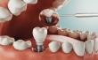 Dental Implants Market Projected To Witness Substantial Growth, 2025-2032: Bicon Dental Implants, Henry Schein Inc.