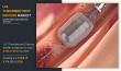 U.S. Thrombectomy Devices Market Size to Achieve USD 750.4 million by 2025, Fueled by a CAGR of 5.1%: Says AMR