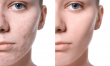 China Scar Treatment Market Projected To Witness Substantial Growth, 2025-2032: Merz Pharma, Luca Pharmaceuticals
