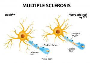 Multiple Sclerosis Therapeutics Size