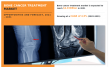 The Global Bone Cancer Treatment Market: A Comprehensive Overview and Future Outlook