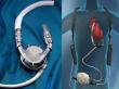 Ventricular Assist Devices Market Projected To Witness Substantial Growth, 2025-2032: Thoratec, Inc., Liva Nova plc