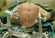 Intraoperative Monitoring Electrodes Market Projected To Witness Massive Growth, 2025-2032 | DIXI Medical, Ambu A/S