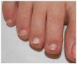 Onychomycosis Market Size to Worth $14.5 Billion By 2034 With a 8.5% CAGR by Exactitude Consultancy