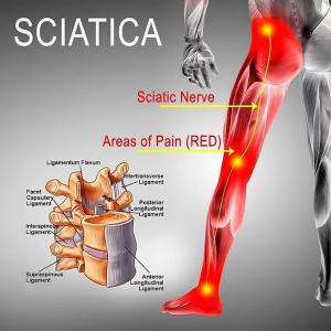 Sciatica Relief in Tampa Florida