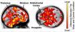 Favorite music sets the brain's opioids in motion