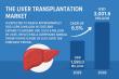Exploring the Role of Artificial Intelligence in Advancing Liver Transplantation: A Glimpse into the Future | FMI