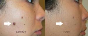 Skin Tag Removal Laser Treatment