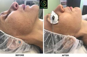 Ipl Photofacial Before And After
