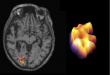 Researchers Identify New Biomarker for Predicting Progression of Multiple Sclerosis