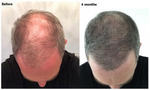 FUE + PRP at Alvi Armani Beverly Hills