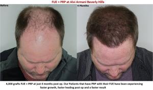Before and After Using PRP