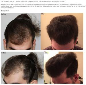 Case Study Using PRP