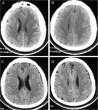 Chinese Neurosurgical Journal Reports Recovery from Subacute Subdural Hematoma using Non-Surgical Therapy