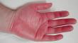 Erythromelalgia Treatment Market Forecasted to Reach USD 3.68 Billion by 2032, CAGR of 5.5%