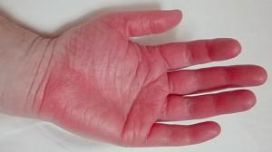 Erythromelalgia Treatment Market Trend