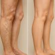 ECCO Medical Partners with KXPX Radio and Univision TV Educating Hispanic Women on Leg Pain and Uterine Fibroids