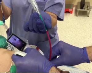 Voir Bougie used with Video Laryngoscope
