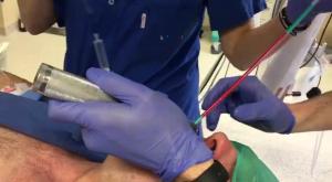 Voir Bougie used with Direct Laryngoscope