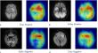 Can AI Help Prevent the Next Stroke? New Study Uses Brain Scans to Detect Hidden Heart Risk