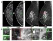 Artificial intelligence-based diagnosis of breast cancer by mammography microcalcification
