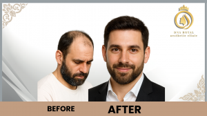 Hair Transplant