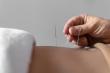 Acupuncture Marketing Pros Launches Online Marketing Services for Acupuncture Clinics in the U.S. and Canada
