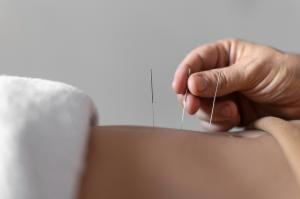 A Traditional Chinese Medicine practitioner performing acupuncture on a patient, representing holistic clinics using digital marketing services.
