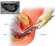 Polycystic Ovary Syndrome (PCOS) Treatment Market Size to Reach US$ 1,666.1 Mn by 2032, Reports Coherent Market Insights