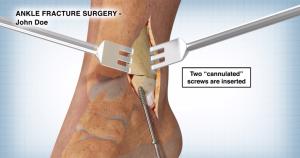 Artery Studio Ankle Fracture Surgery