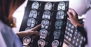 Doctor holding up image of Alzheimer's patient's brain scan