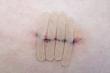 Stem Health Plus Provides Expert Care for Those Experiencing Post-Surgical Healing