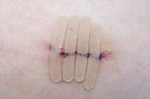Close-up of a healing skin biopsy site with visible suture stitches and wound closure strips securing the incision.