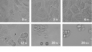 Photographs of Lung Cancer Treated with MicroQuin's Drug and monitored over 24 hr