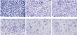 Chinese Neurosurgical Journal Report Identifies FAM111B as Key Molecular Driver of Glioma Progression