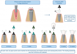 Timeline of sample collection from the peri-implant sulcus following two-stage dental implant placement, highlighting the role of the coverscrew chamber as the initial microbial source.