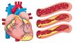 Atherosclerosis Market to Reach USD 62.2 Billion by 2035, Growing at 2.7% CAGR