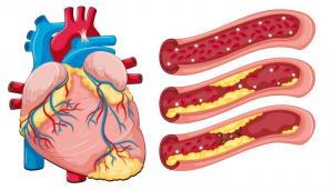 Atherosclerosis Market