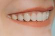 Comparing Veneers and Bonding: Choosing the Right Path to an Improved Smile