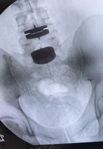 Dr. Georgiy Brusovanik, a spine surgeon himself,  underwent two disc replacements