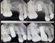 Greater New York Dental Meeting 2024 - Dental Implants, Soft Tissue & Bone Grafts to Rehabilitate Oral Health and Smile