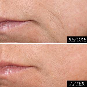 Joanne_lee_Kaplan_before&after