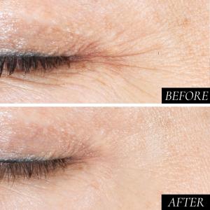 3_Joanne_Eye_before_and_after