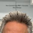 Dr. Doris Launches Advanced PRP Hair Restoration Treatments in Beverly Hills to Restore Hair Naturally and Safely