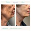 Undo Summer Skin Damage: Polaris Offers Mid-Summer Facial Rescue Treatments