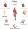Rheumatoid Arthritis and Muscle Wasting: New Review Points to Overlooked Complications
