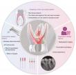 Expert strategies unveiled to tackle fractured instruments in dental procedures