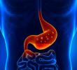 Erosive Esophagitis Market Epidemiology Report 2025-2035: Pipeline Therapies, Drugs Sales, and Regional Outlook